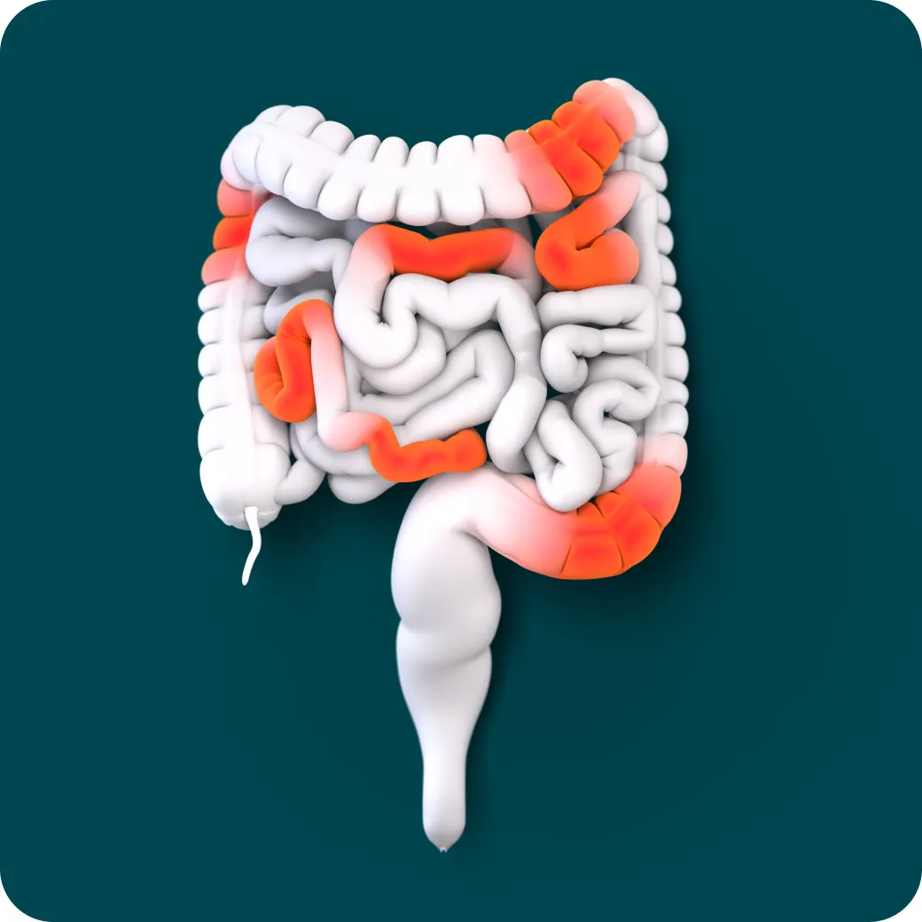 Inside of a digestive tract – Crohn's disease