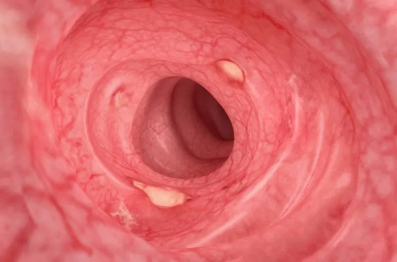 Inside of a digestive tract – mild Crohn’s