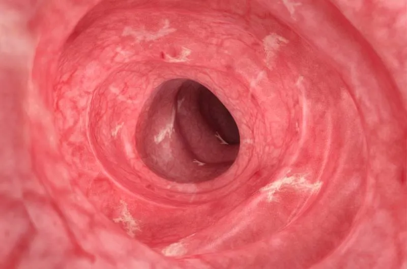 Inside of a digestive tract – mild UC