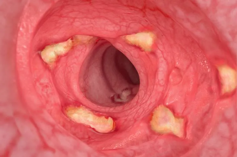 Inside of a digestive tract – moderate-severe Crohn’s