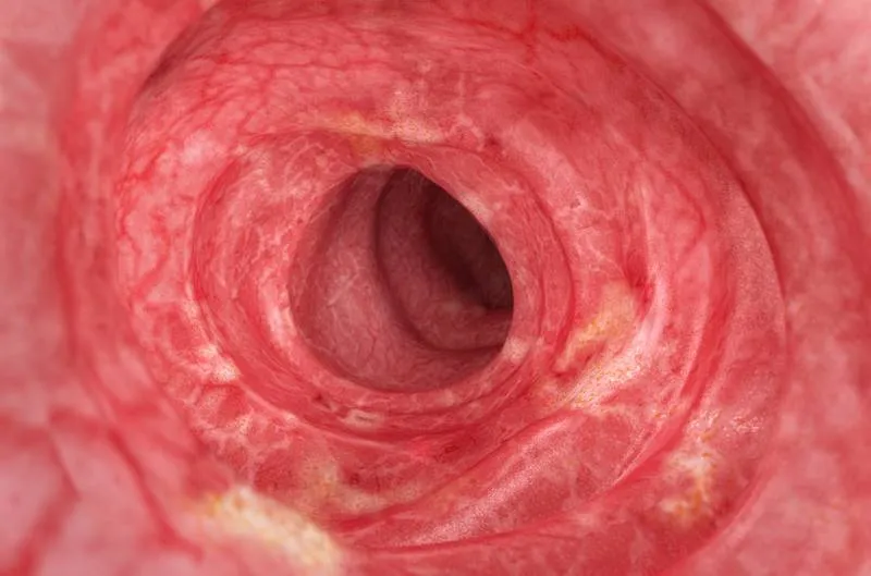 Inside of a digestive tract – moderate-severe UC