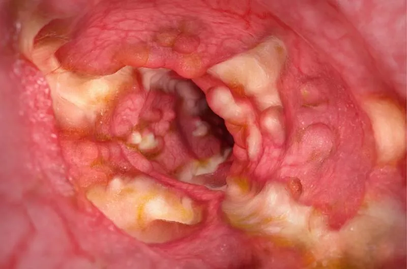 Inside of a digestive tract – severe-fulminant Crohn’