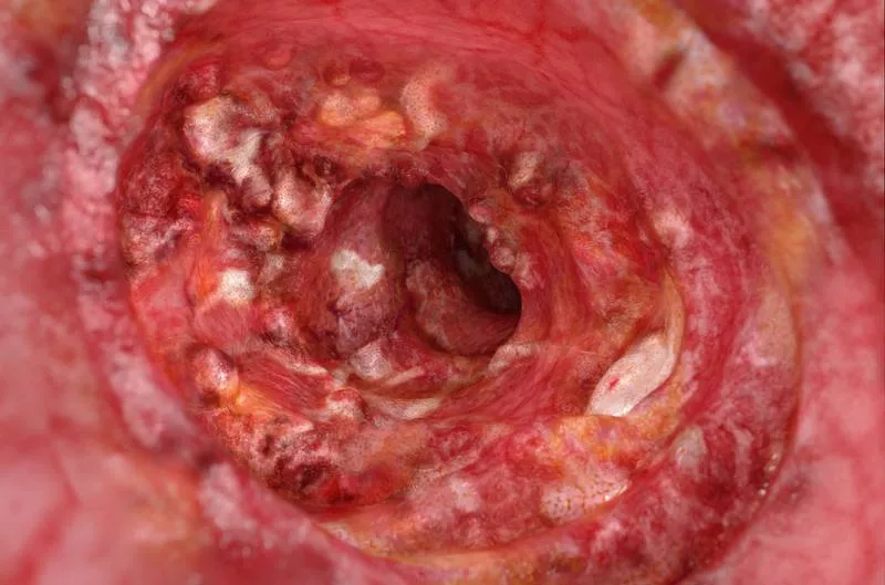 Inside of a digestive tract – severe-fulminant UC