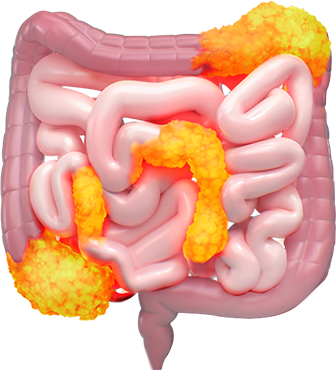 Crohn's disease inflamed intestine.