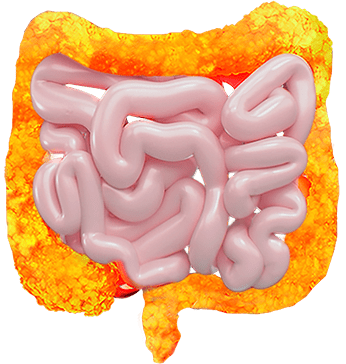 Ulcerative colitis inflamed intestine.